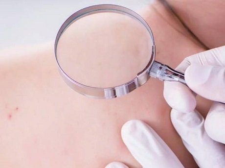 cura dermatite bollosa