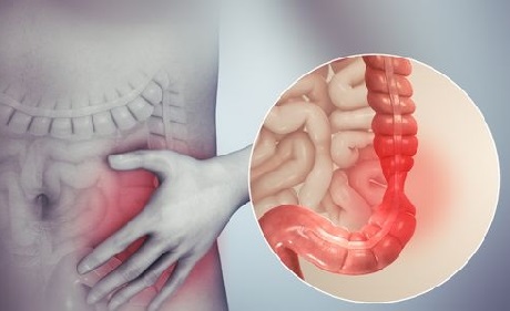 colon irritabile