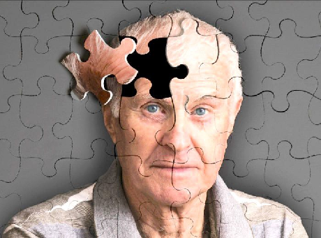 alzheimer fasi
